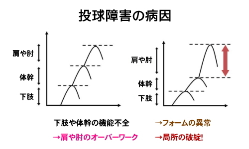 投球障害の原因
