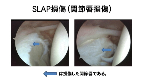 SLAP損傷