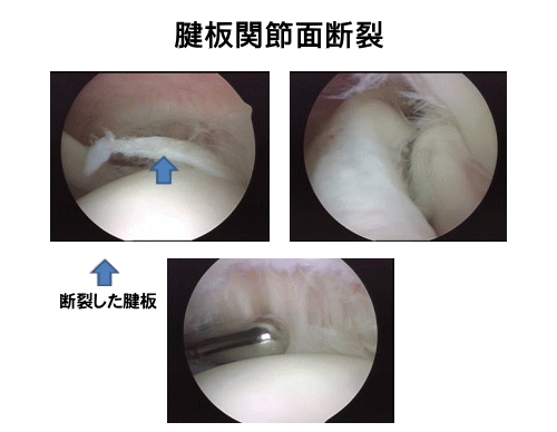 腱板関節面断裂