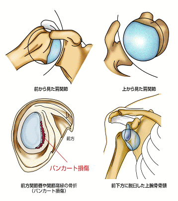 反復性肩関節脱臼