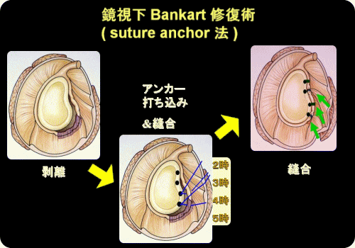 鏡視下Bankart修復術