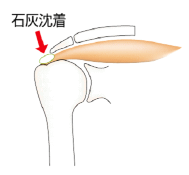 石灰沈着