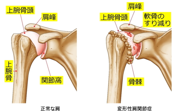 変形性肩関節症