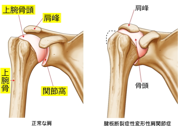 腱板断裂症性変形性肩関節症