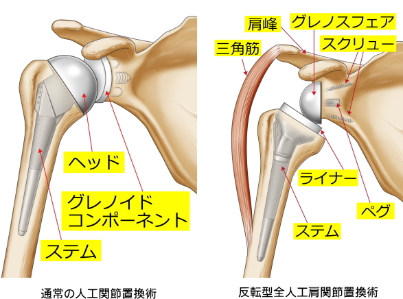反転型全人工肩関節置換術