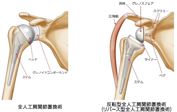 全人工肩関節置換術と反転型全人工肩関節置換術