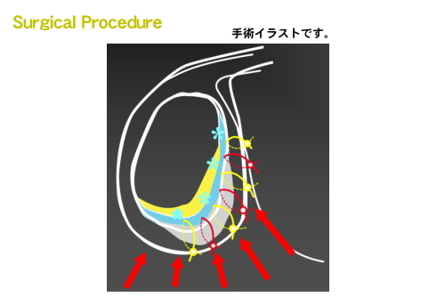 SurgicalProcedure