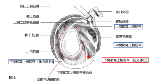 手術では、関節鏡視下で関節唇の縁の関節包を切離