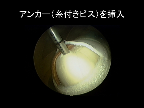 アンカー(糸付きビス)を挿入