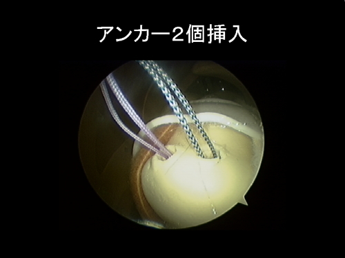 アンカー2個挿入
