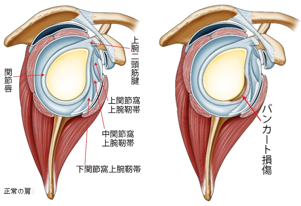 バンカート損傷