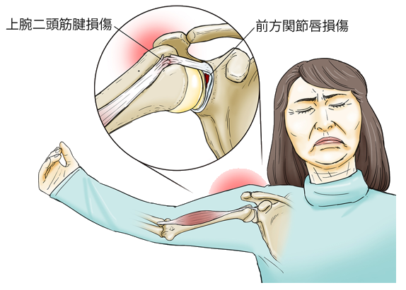 上腕二頭筋腱損傷のおこる仕組み