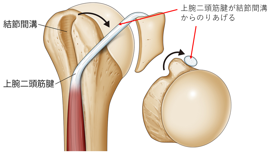 上腕二頭筋腱損傷のおこる仕組み