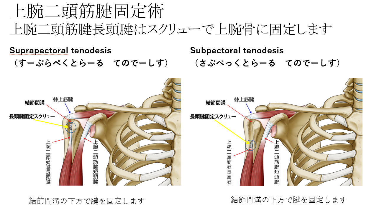 上腕二頭筋腱固定術