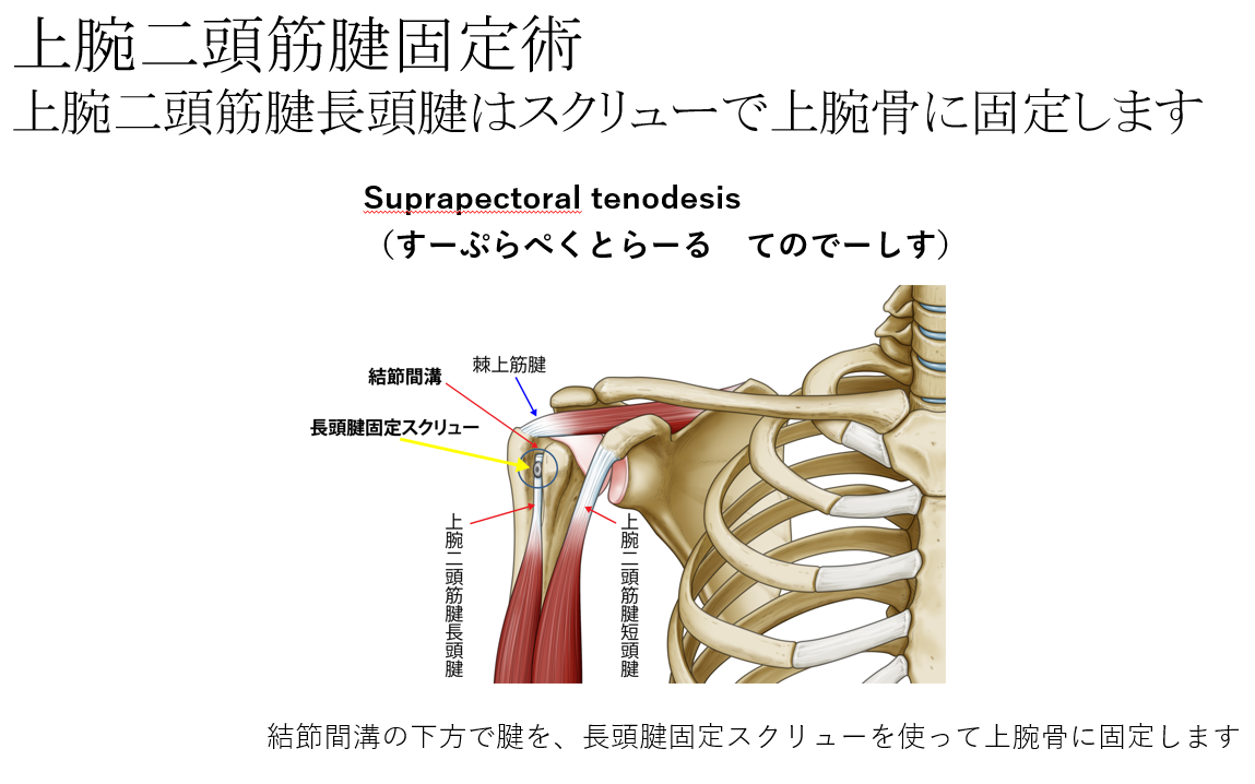 鏡視下上腕二頭筋腱固定術