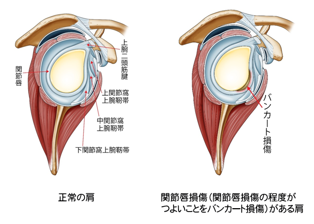 非外傷性肩関節症