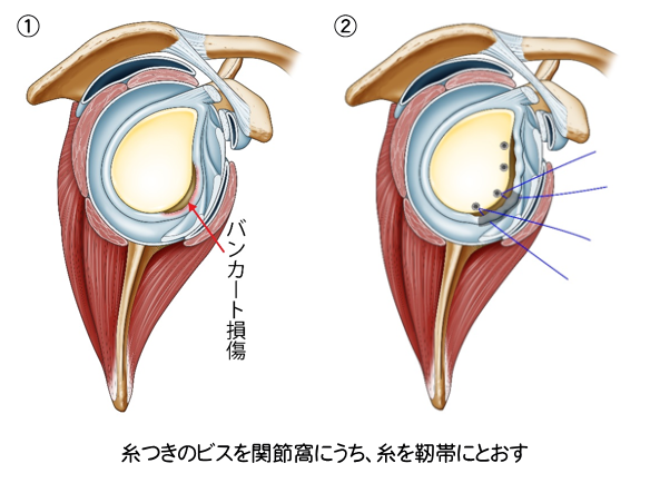 鏡視下関節唇修復術、脱臼制動術