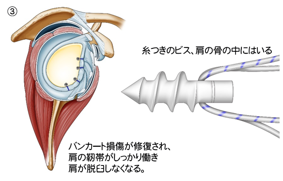 鏡視下関節唇修復術、脱臼制動術