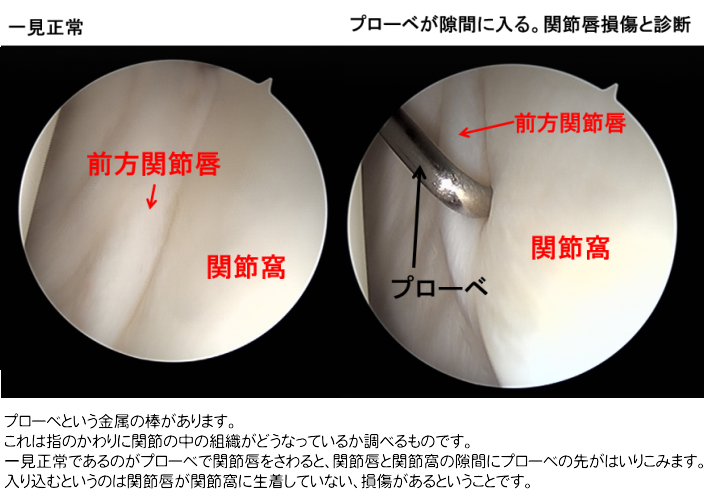 関節鏡写真1