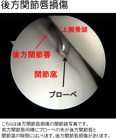 関節鏡写真2