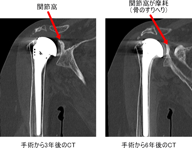 CT でよくみると関節窩がすりへっています