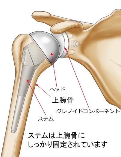 上腕骨を割るような処置