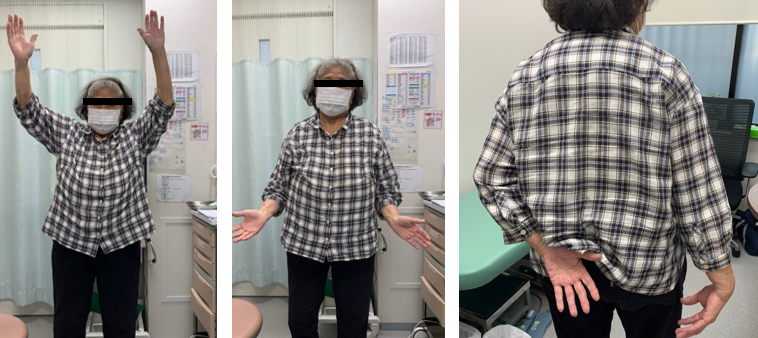 術後3年