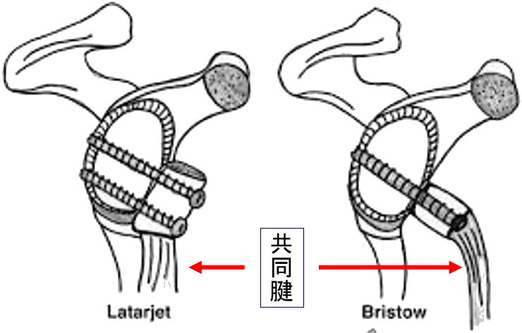 烏口突起移行術
