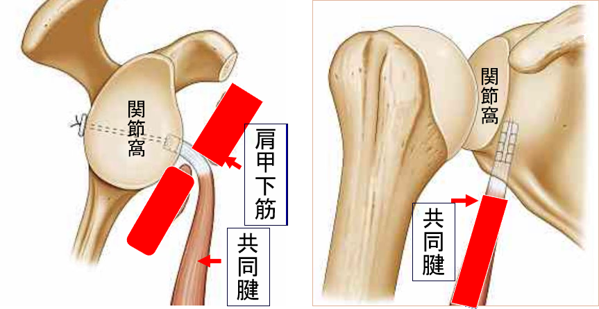 烏口突起共同筋腱移行術