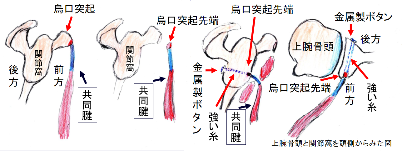 烏口突起共同筋腱移行術