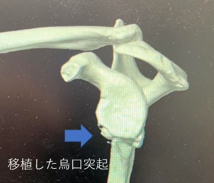 手術後4ヶ月