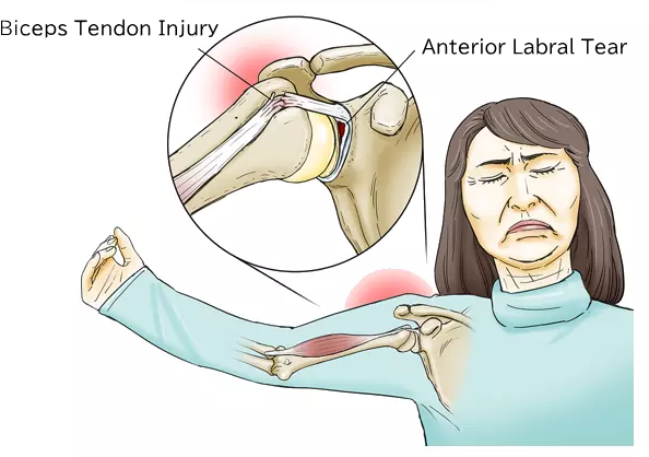 Biceps tendon injury・Anterior labral tear