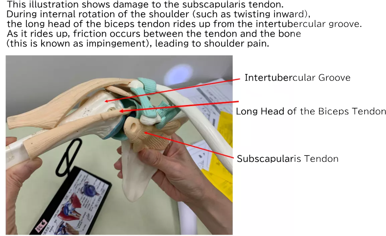 Subscapularis tendon injury