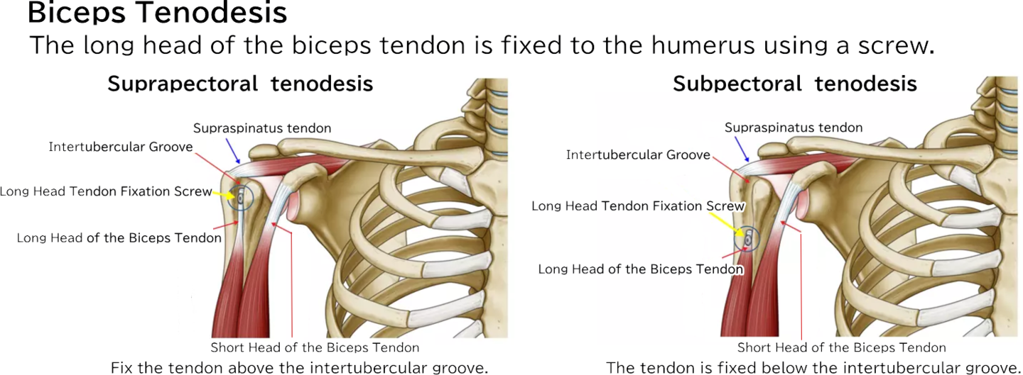 Biceps Tenodesis