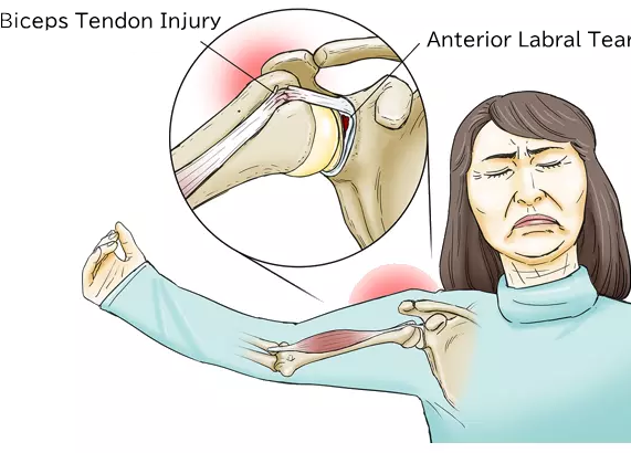 Biceps tendon injury・Anterior labral tear