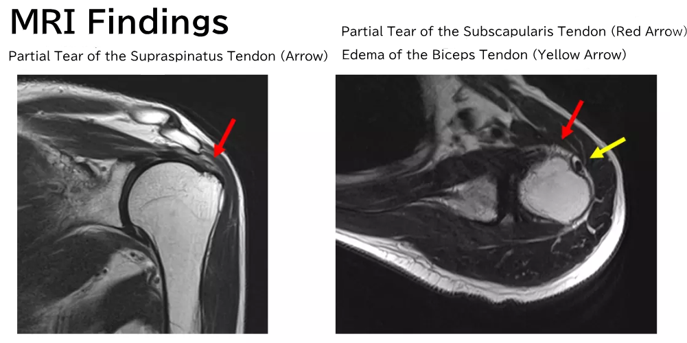 MRI Findings