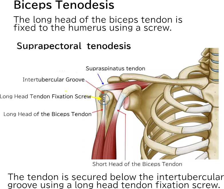 Biceps Tenodesis