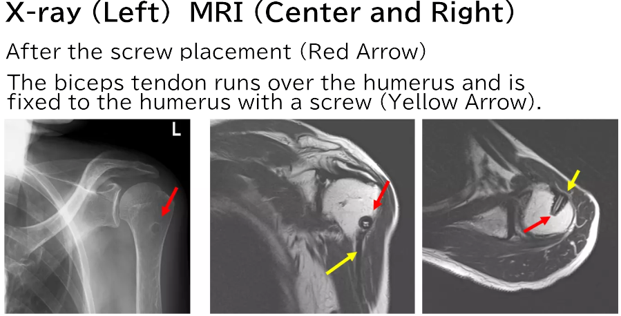 X-ray (Left) MRI (Center and Right)