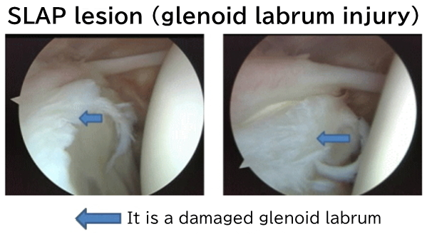 SLAP lesion (glenoid labrum injury)