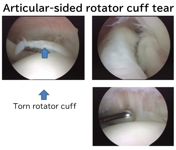 Articular-sided rotator cuff tear