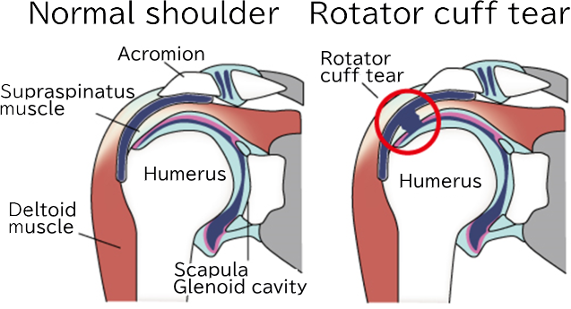 Rotator cuff tear, Rotator cuff injury