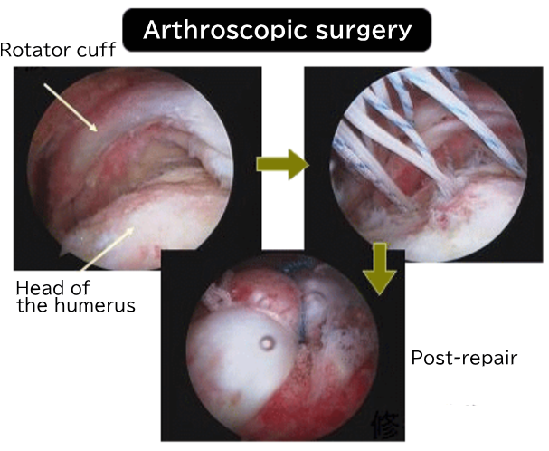 Arthroscopic surgery