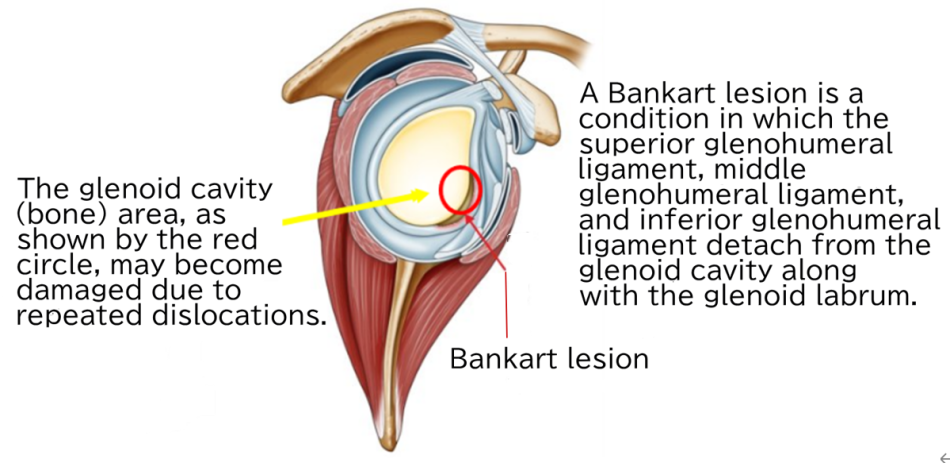 Bankart lesion