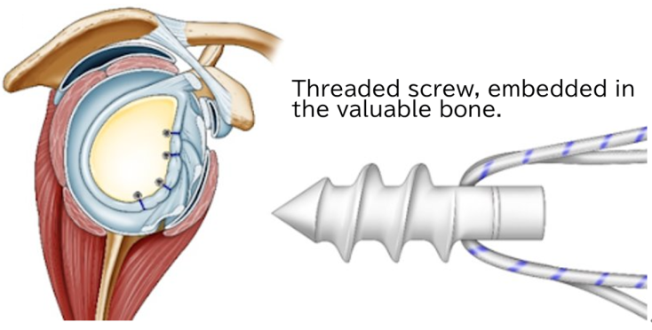 Arthroscopic Bankart repair