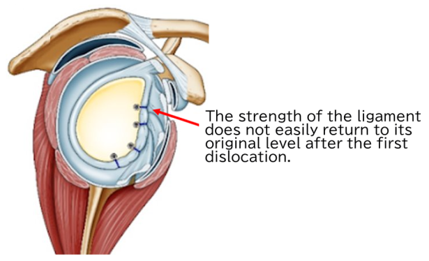 recurrent dislocation