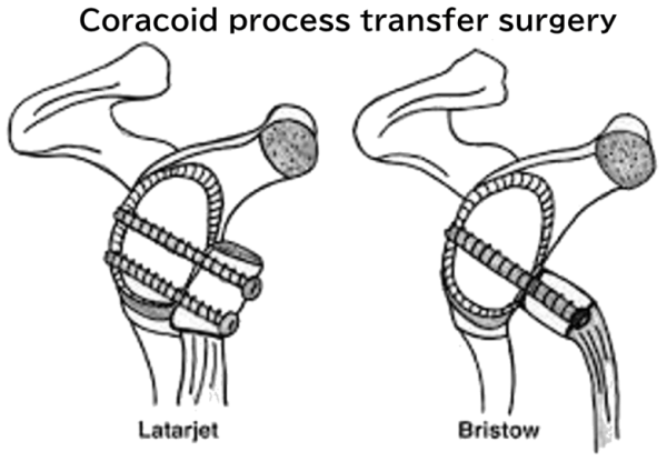 Coracoid process transfer surgery