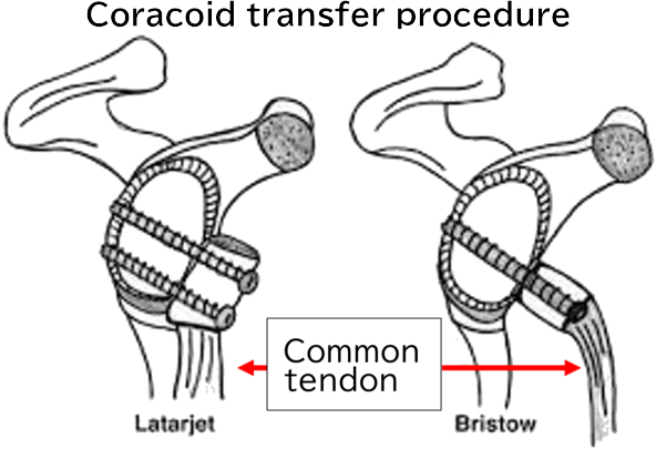 Coracoid transfer procedure
