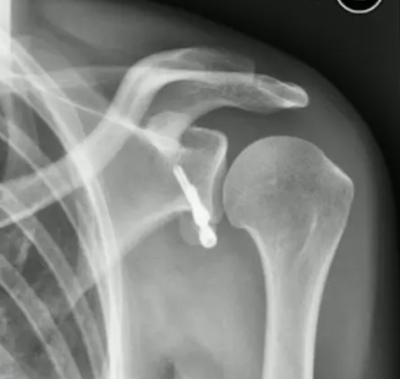 X-ray of Latarjet procedure