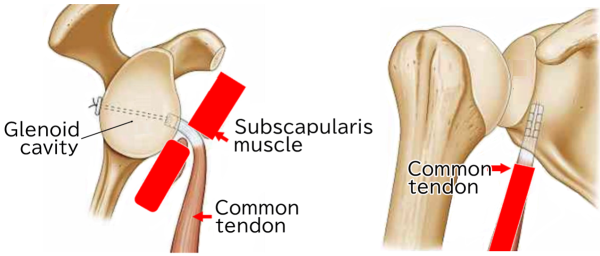 Coracoid tip-conjoined tendon transfer