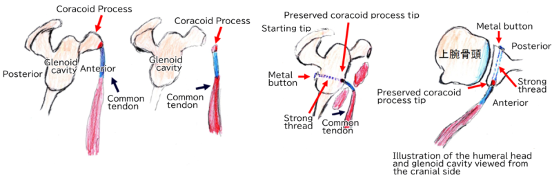 Coracoid tip-conjoined tendon transfer